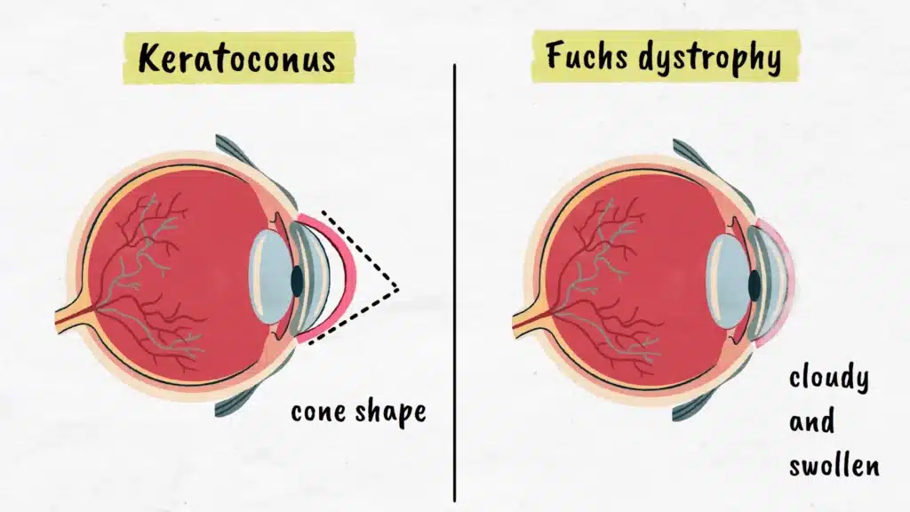 Keratoconus and fuchs dystrophy