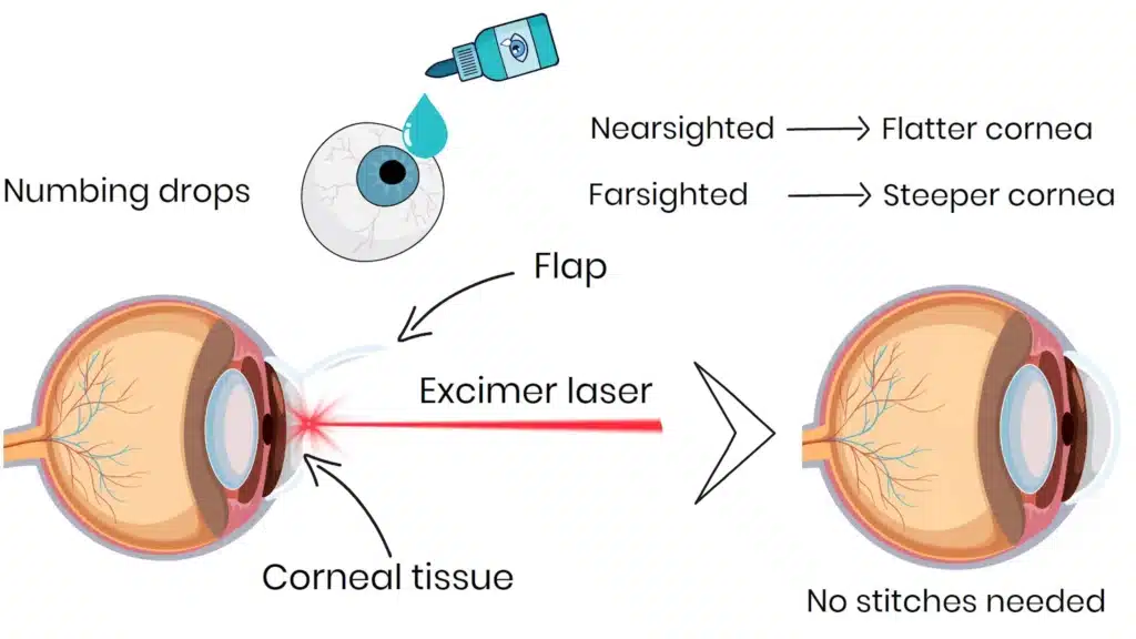LASIK surgery excimer laser
