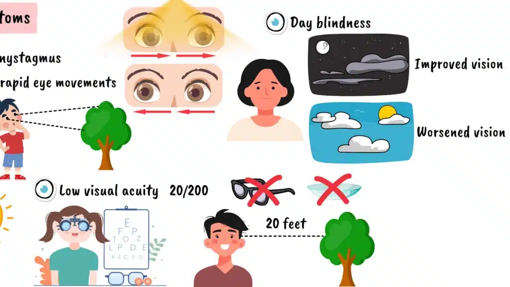 More Achromatopsia symptoms