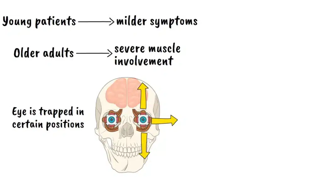 Muscle Swelling and Double Vision