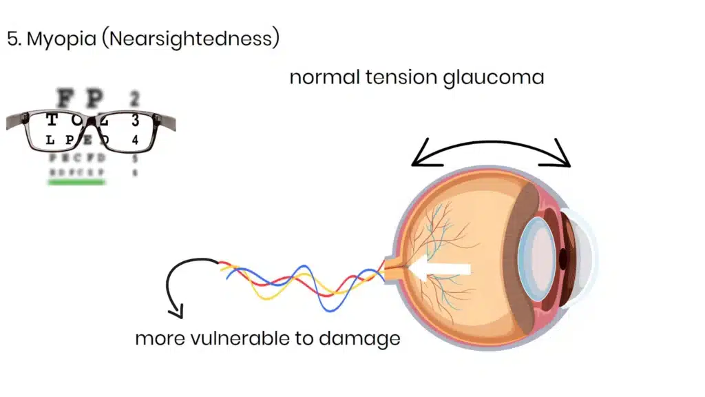 Myopia Glaucoma Risk Factors
