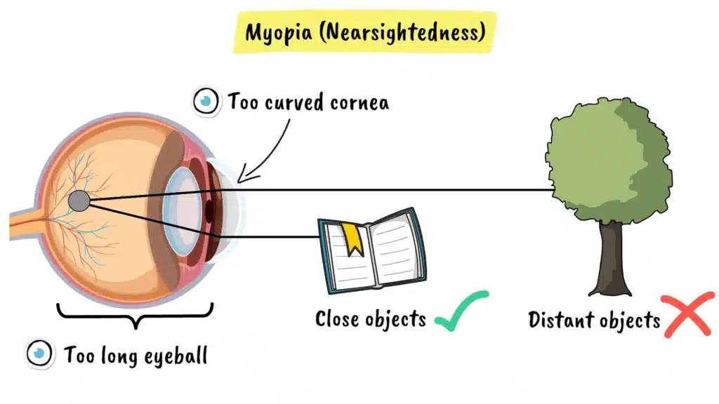 Myopia (Nearsightedness) explained