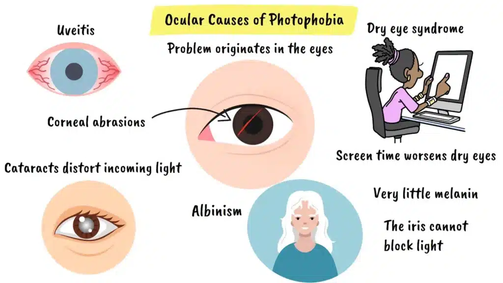 Ocular Causes of Photophobia