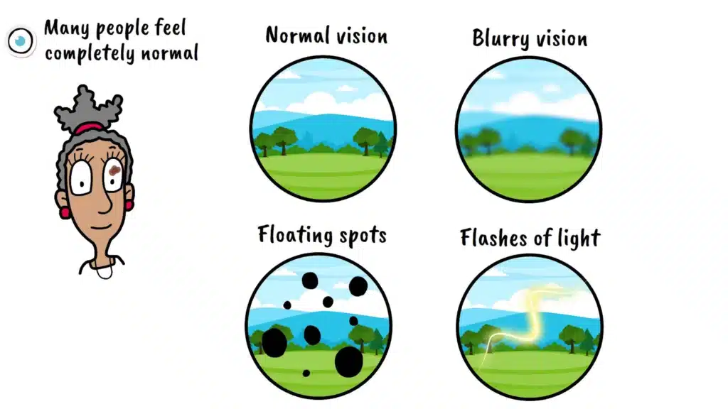 Ocular Melanoma Symptoms
