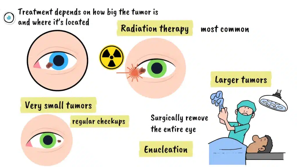 Ocular Melanoma Treatment