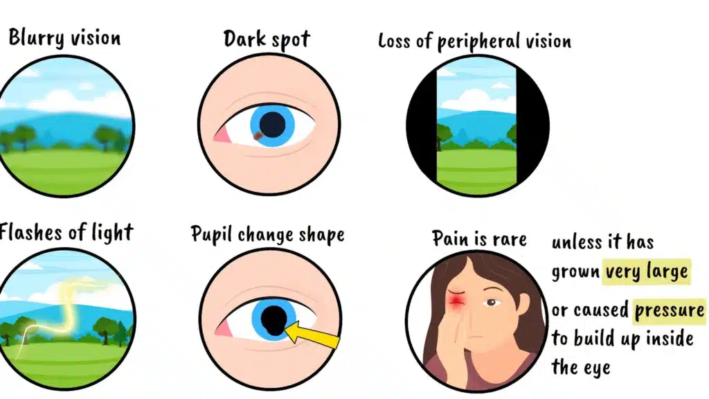 Ocular Melanoma dark spot