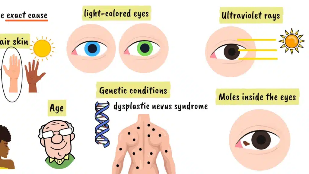 Ocular Melanoma diagnosis