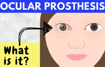 Ocular Prosthesis: What to Know