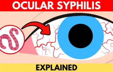 Ocular Syphilis: Diagnosis & Treatment