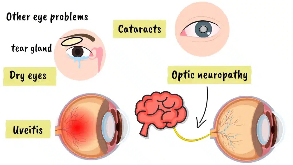 Other eye problems related to AIDS