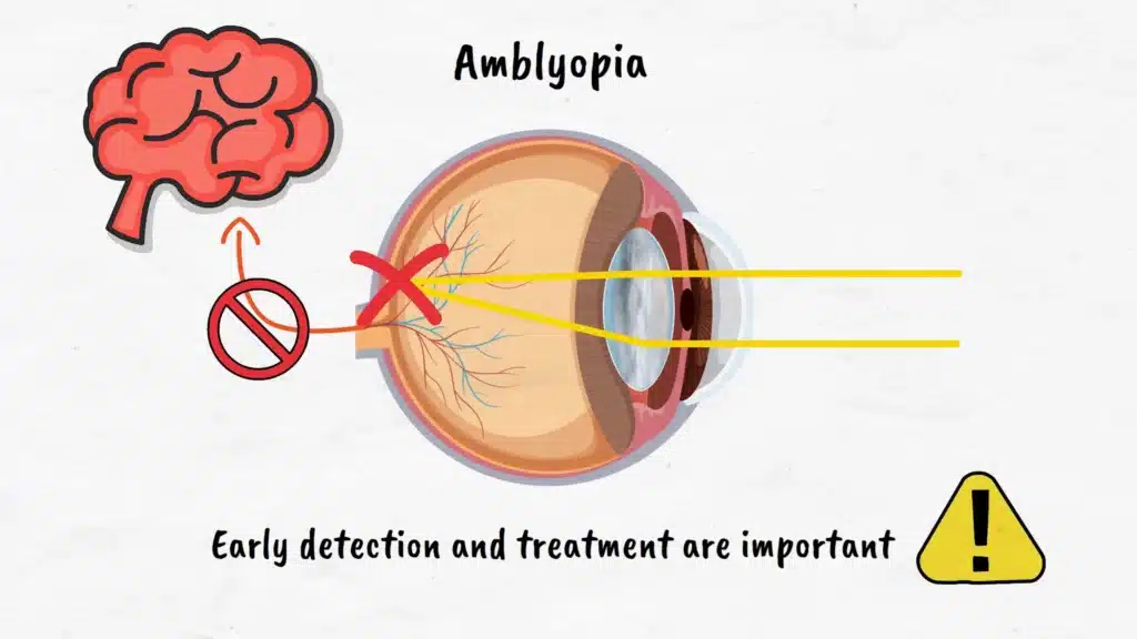 Pediatric Cataracts Amblyopia