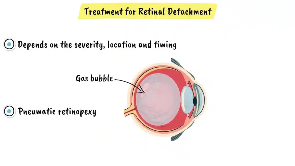 Pneumatic Retinopexy