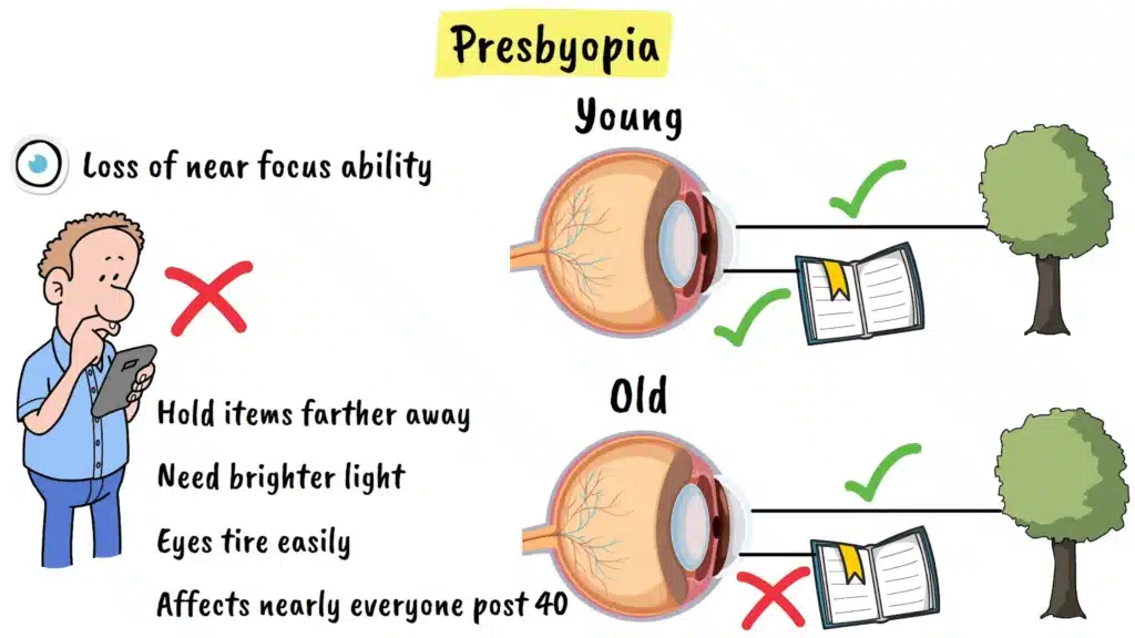 Presbyopia