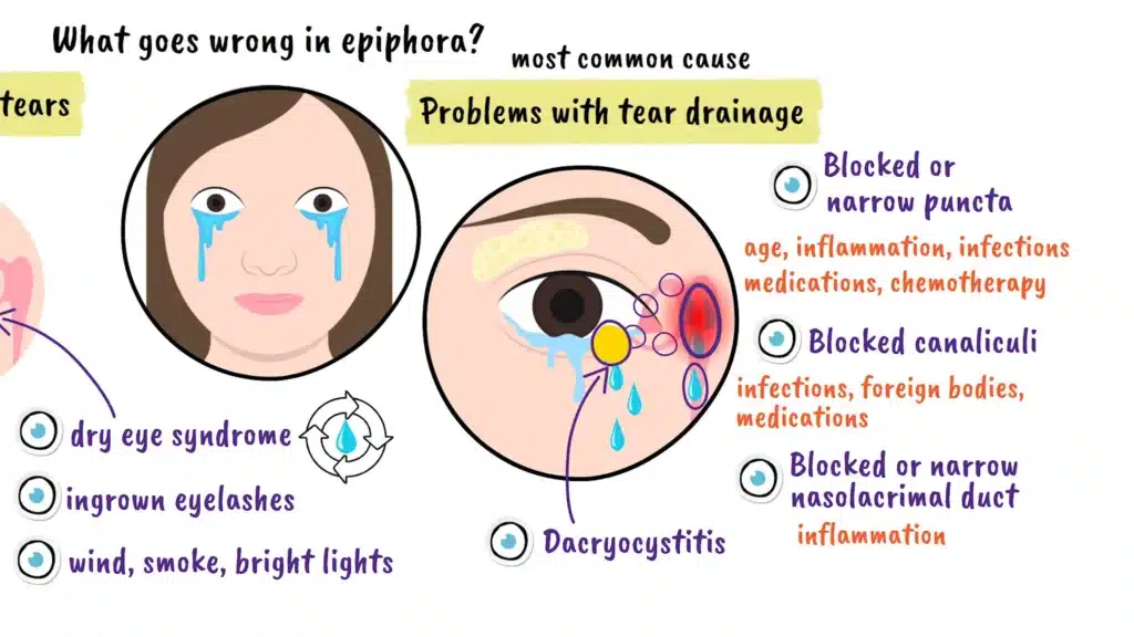 Problems with tear drainage
