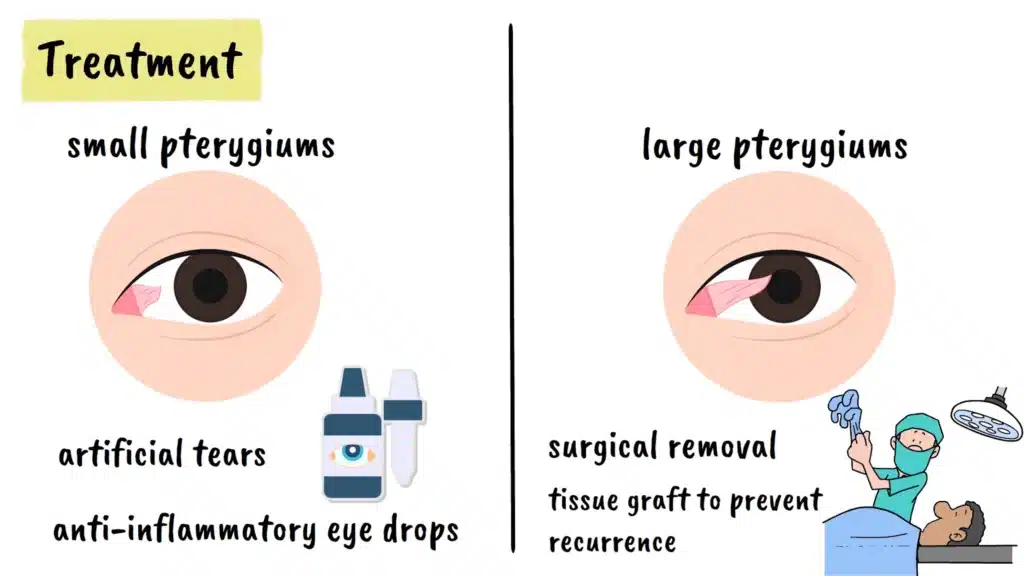 Pterygium Treatment