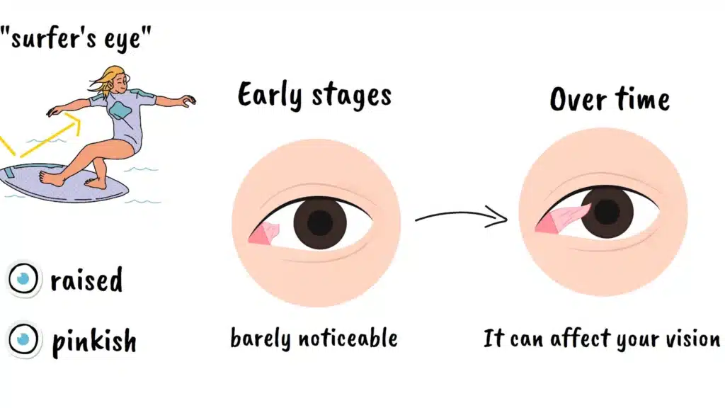 Pterygium stages
