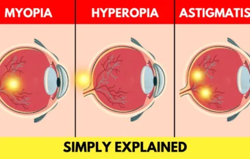 Myopia, Hyperopia & Astigmatism: Explained