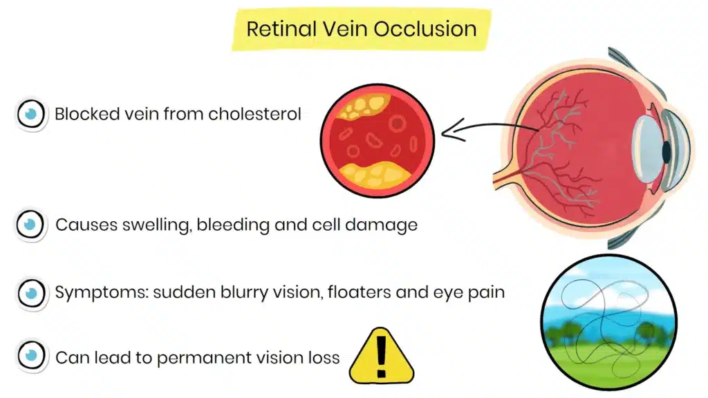 Retinal vein occlusion