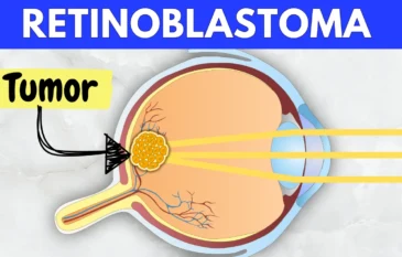 Retinoblastoma: Causes, Symptoms & Treatment