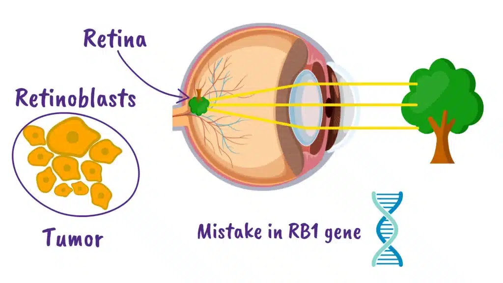 Retinoblastoma what are retinoblasts