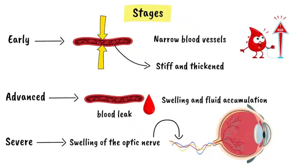 Stages of Hypertensive Retinopathy