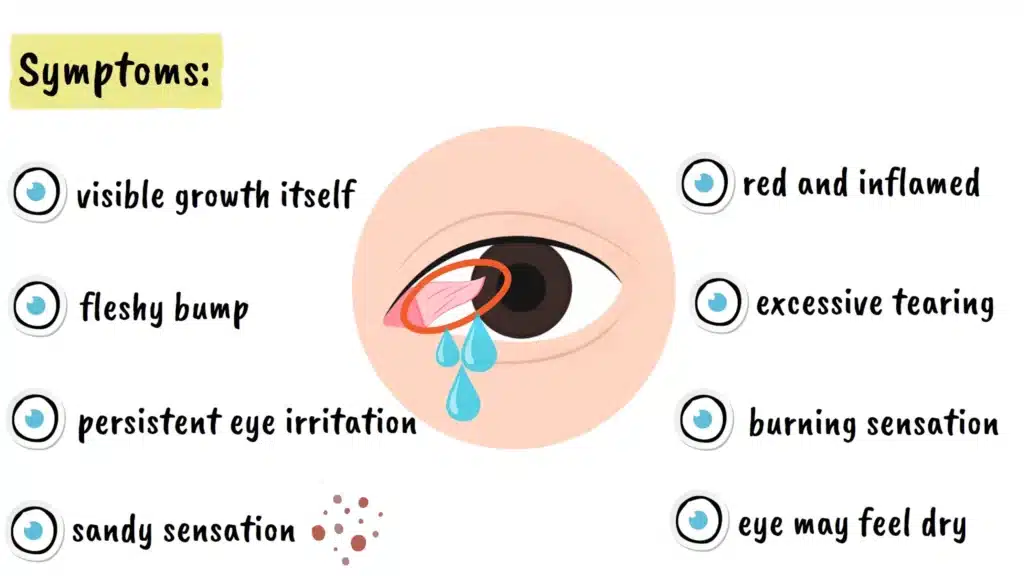 Symptoms of Pterygium