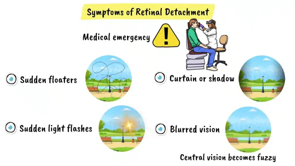 Symptoms of Retinal Detachment