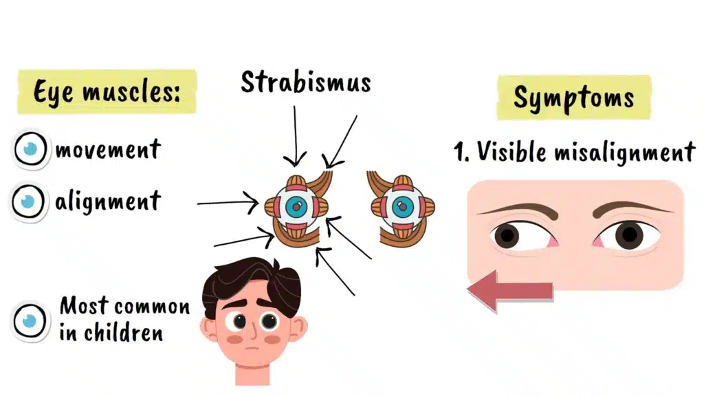 Symptoms of strabismus