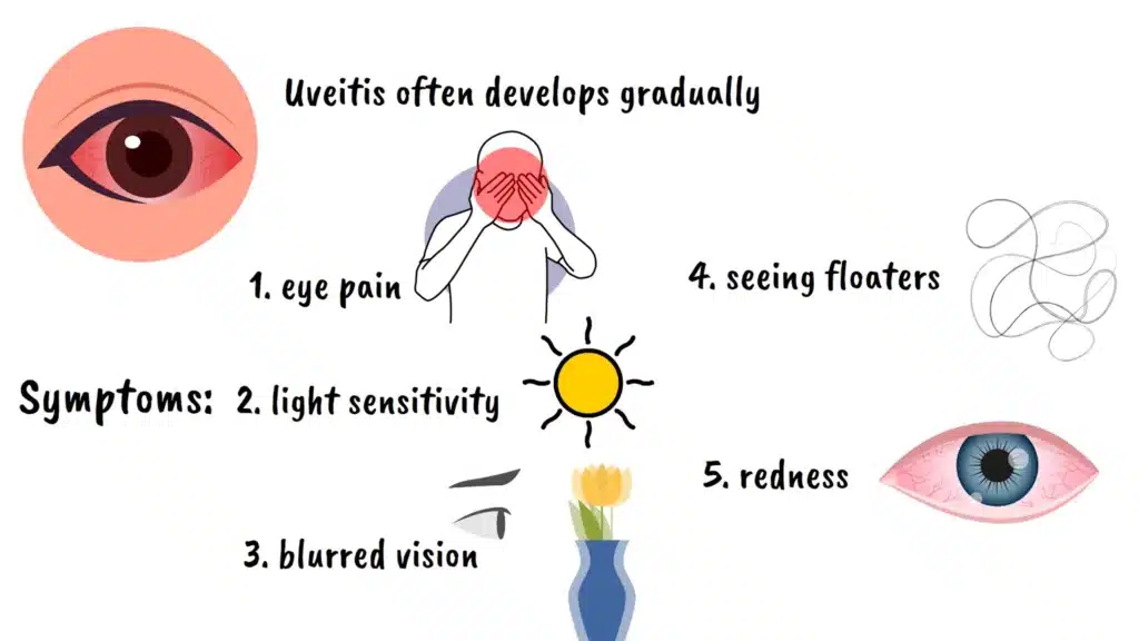 Symptoms of uveitis