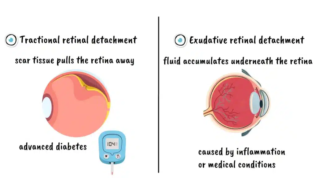 Tractional and Exudative Retinal Detachment