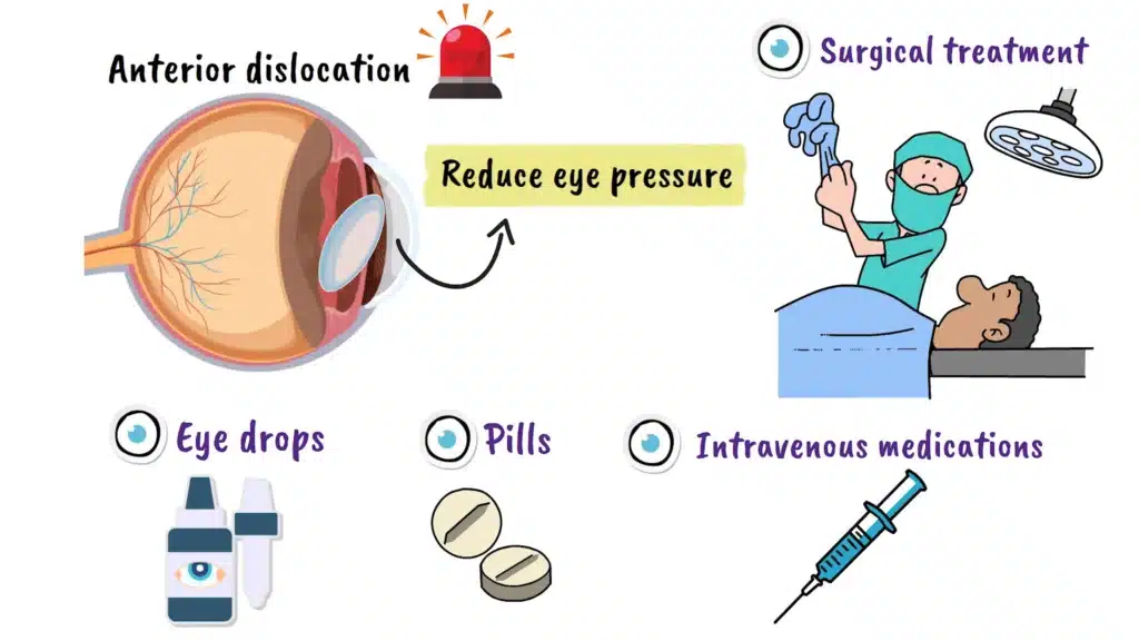 Traumatic Lens Dislocation anterior dislocation treatment