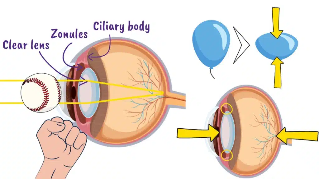 Traumatic Lens Dislocation explained
