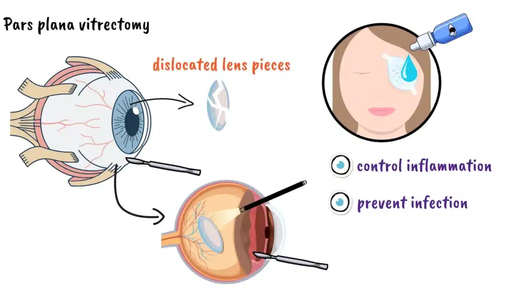 Traumatic Lens Dislocation pars plana vitrectomy