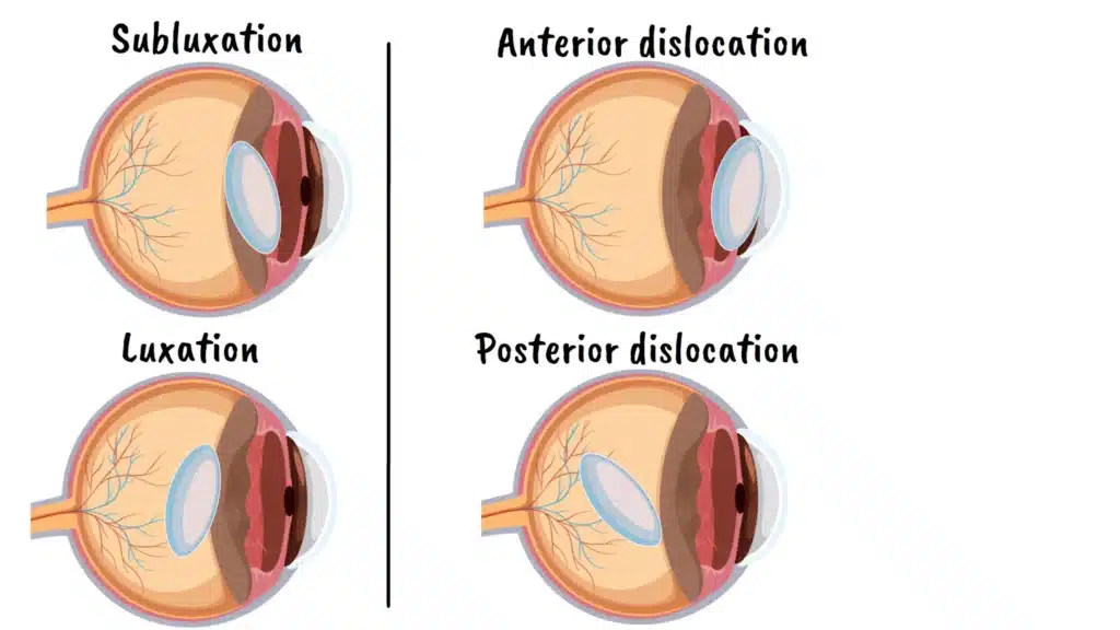 Traumatic Lens Dislocation subluxation and luxation
