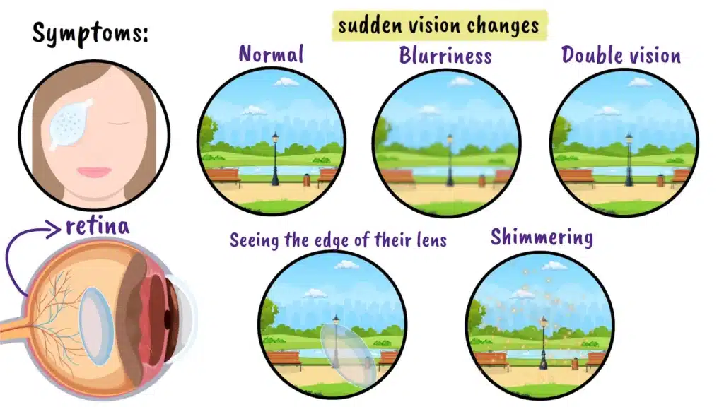 Traumatic Lens Dislocation symptoms