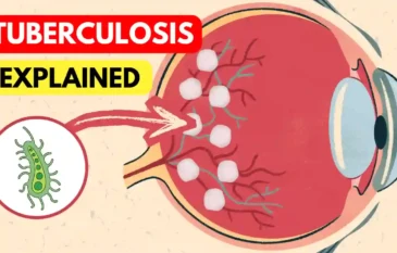 Tuberculosis & Eyes: Symptoms & Care