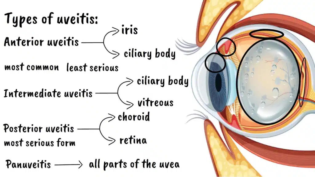 Types of uveitis