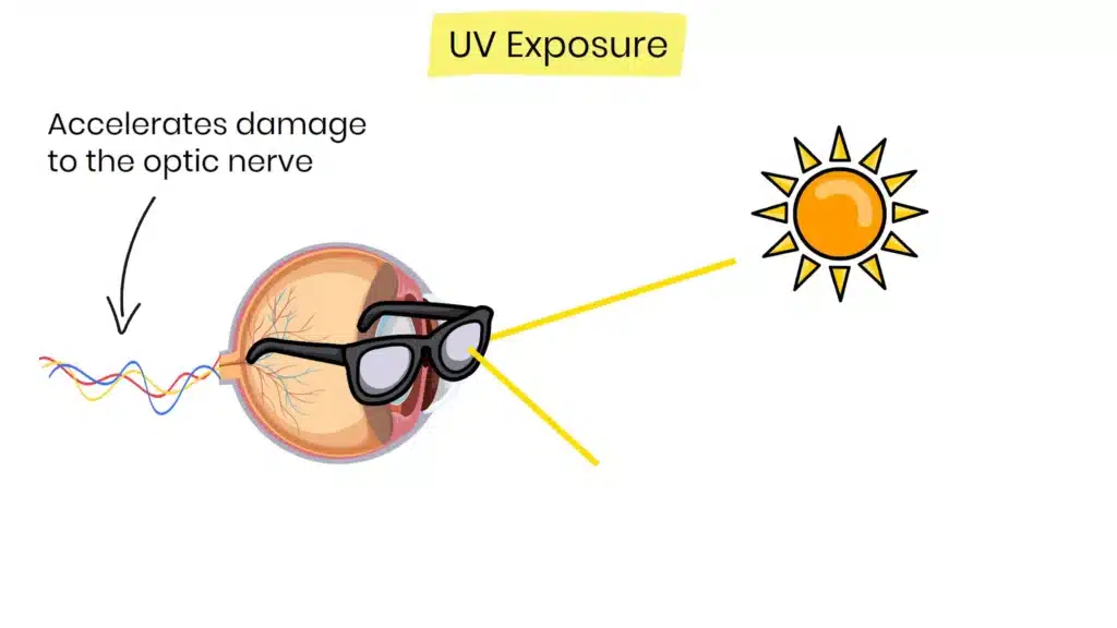 UV exposure Glaucoma Risk Factors