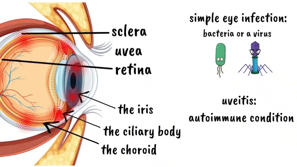 Uvea and Uveitis