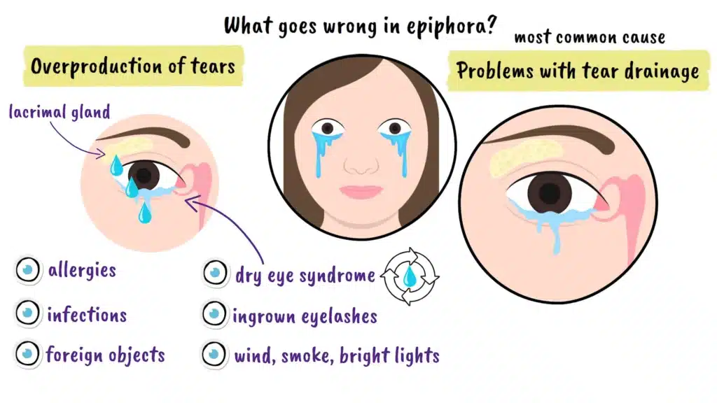 What goes wrong in epiphora