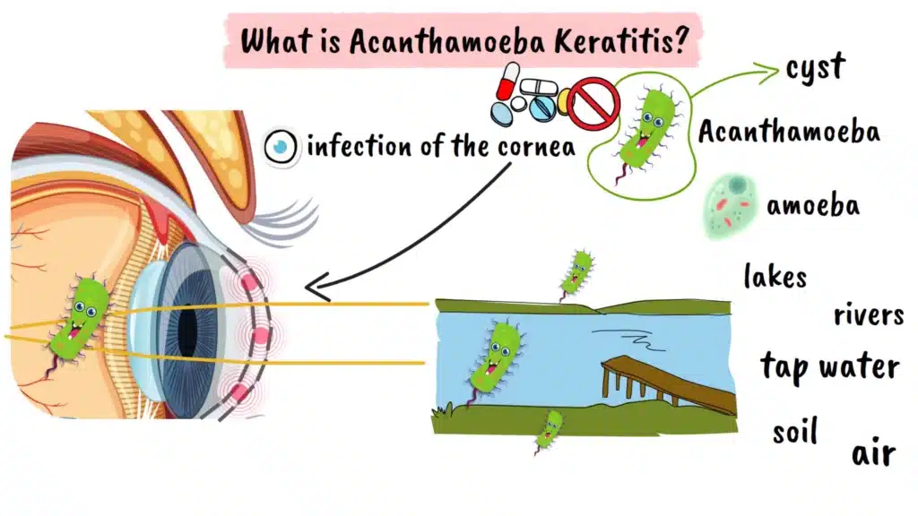 What is Acanthamoeba Keratitis?