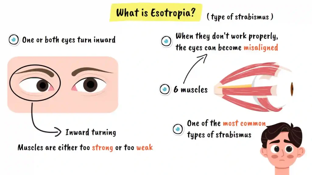 What is Esotropia