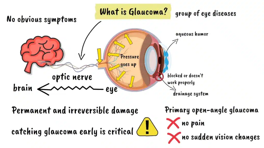 What is Glaucoma