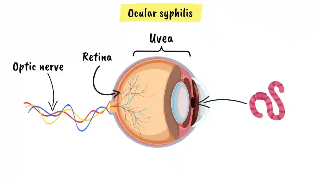 What is Ocular Syphilis