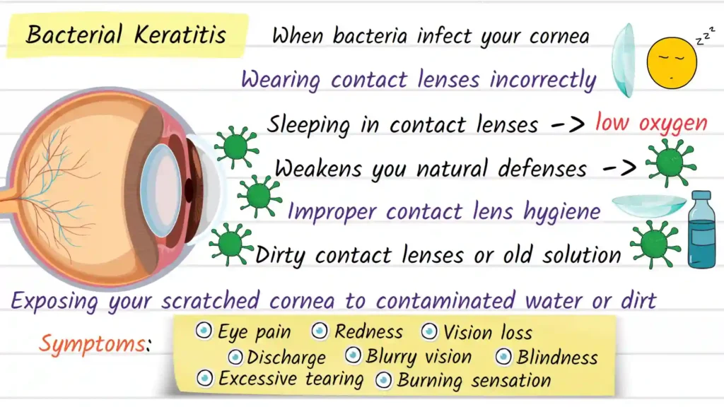 What is bacterial keratitis