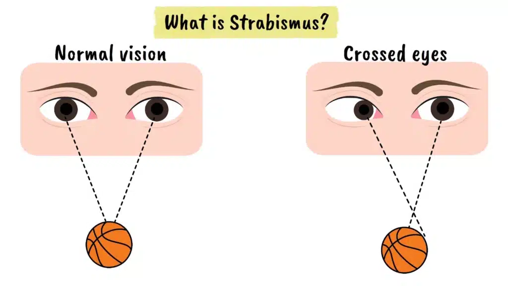 What is strabismus