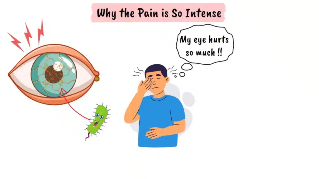 Why the pain is so intense in Acanthamoeba Keratitis