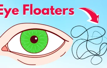 Eye Floaters Explained