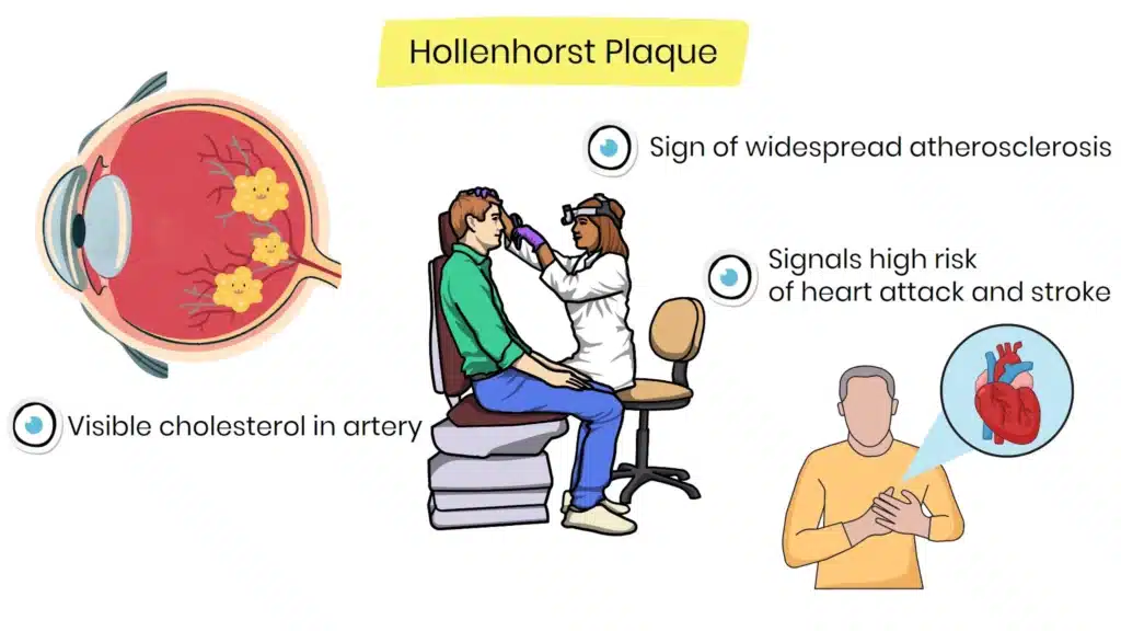 Hollenhorst plague