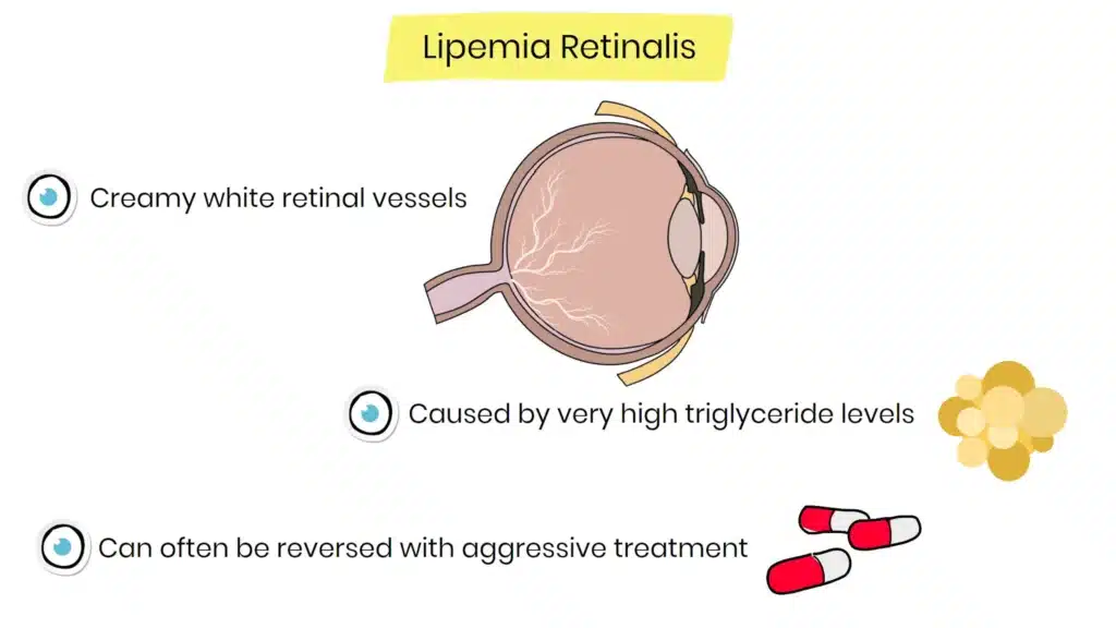 lipemia retinalis